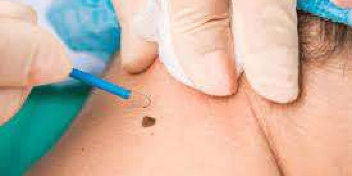 "Erase Unwanted Moles: Dubai’s Leading Mole Removal Techniques"