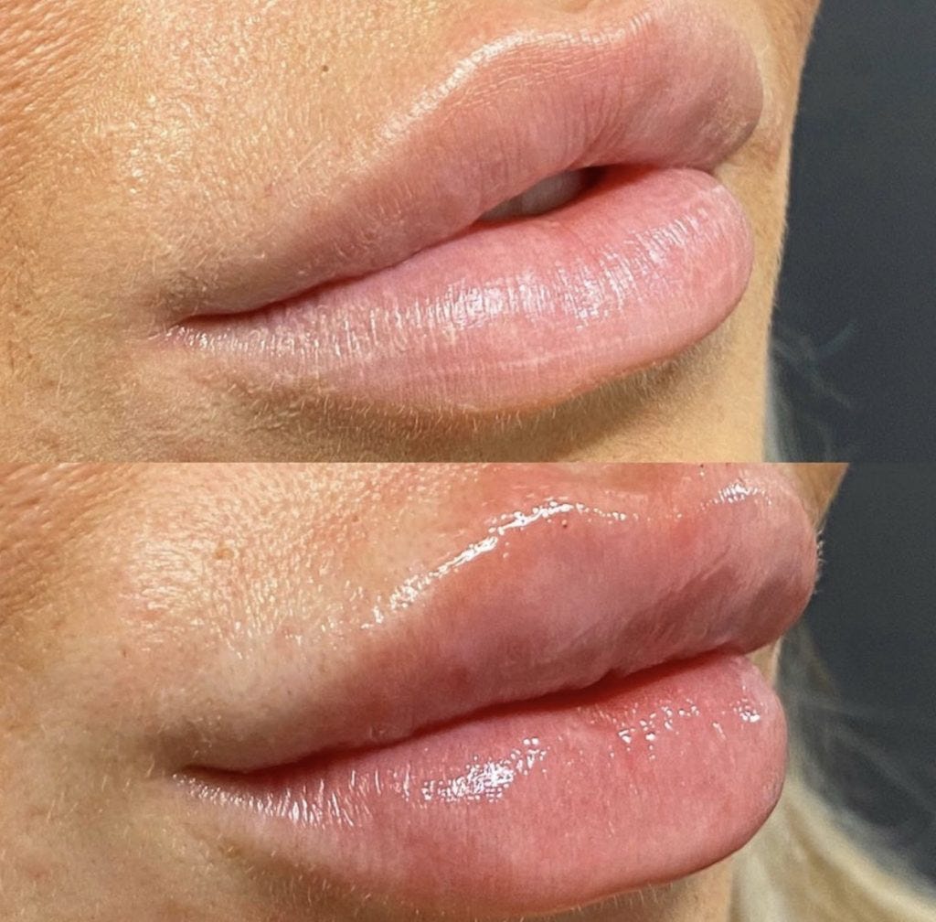 Unveiling the Art of the Russian Lip: A Guide to Natural Enhancement at Eclipse Beauty, Bexleyheath | by Eclipsebeautys | Jun, 2024 | Medium