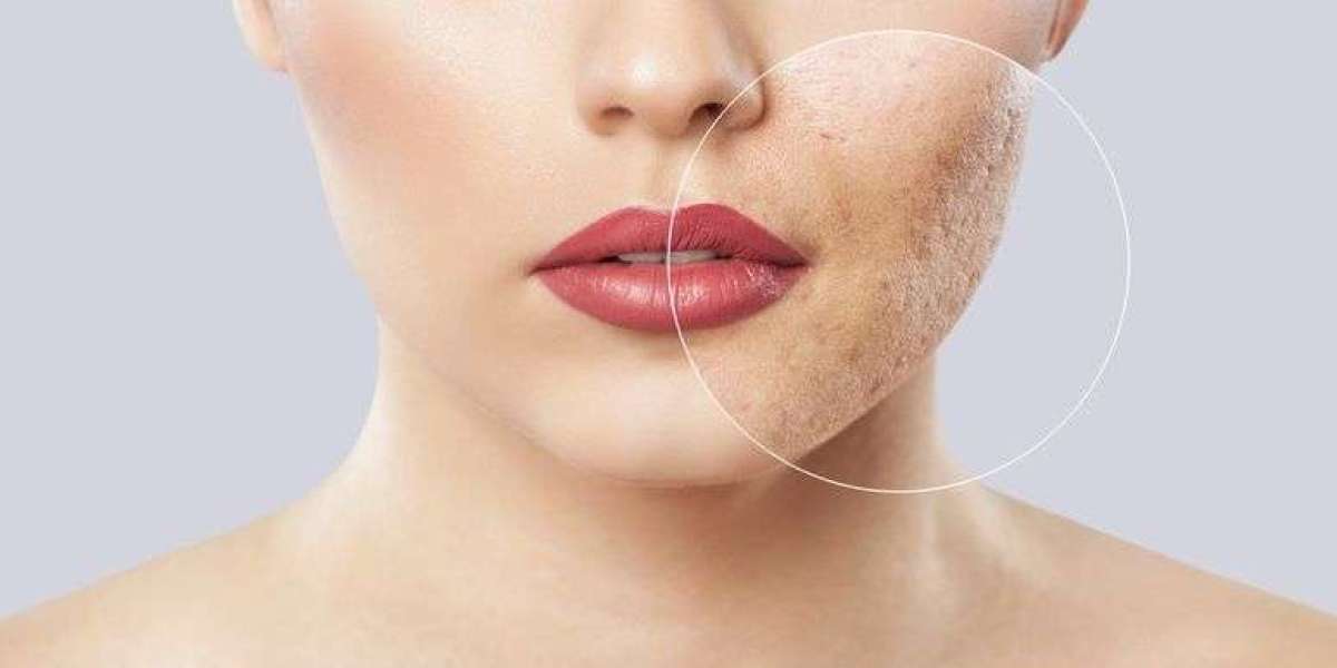 Transform Your Skin: Best Acne Scar Treatments in Dubai