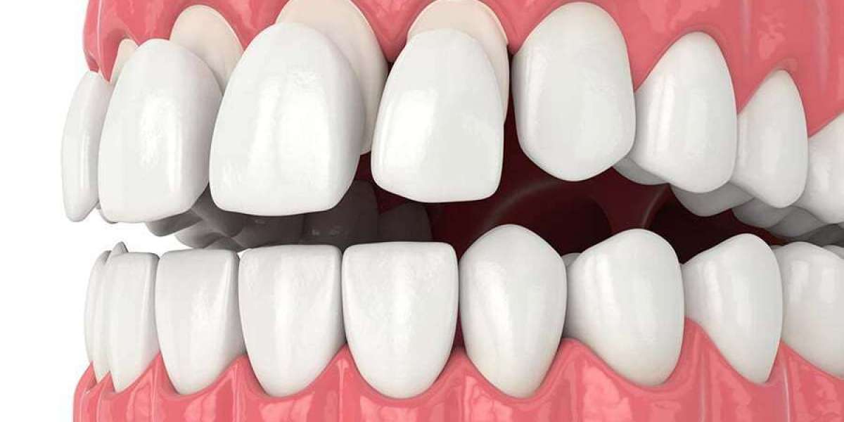 Why Composite Veneers Are the Top Choice for Dubai Residents